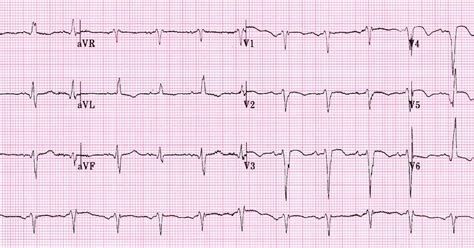 ventricular aneurysm ecg.